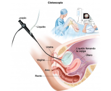 Метод диагностики в урологии основанный на визуальном эндоскопическом осмотре мочевого пузыря и мочеполовой системы.