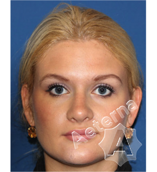 Ринопластика (пластика носа) фото до и после