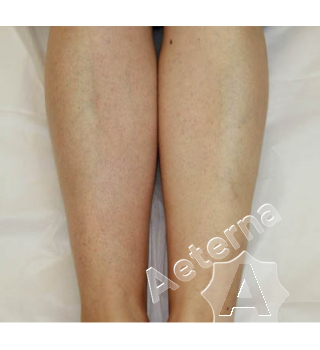 Лазерная эпиляция ног александритовым лазером фото до и после