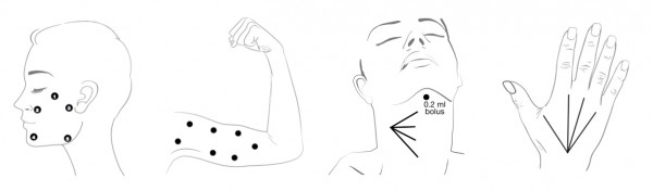 Точки введения препарата Профайло - лицо,шея, руки