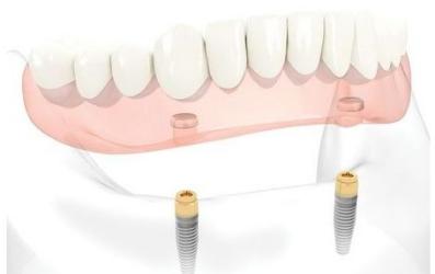 Протезирование на имплантатах при полном отсутствии зубов
