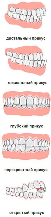 Перекрестный прикус схема