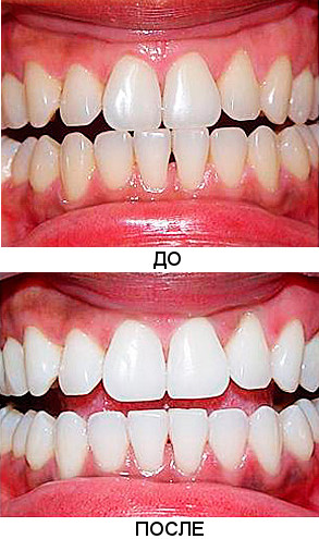 Отбеливание зубов ZOOM фото до и после