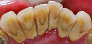 чистка зубов от зубного налета и камня